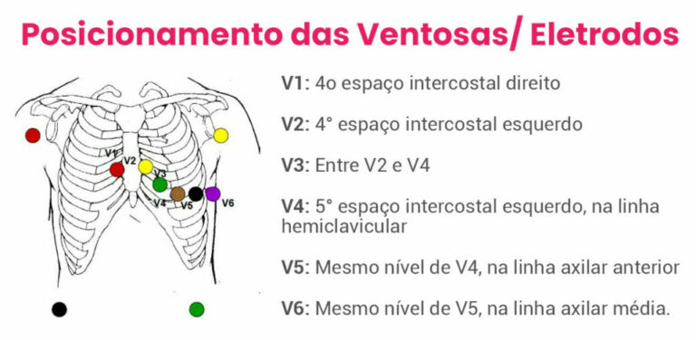 O Que é E Como é Feito O Eletrocardiograma Entenda Neomed