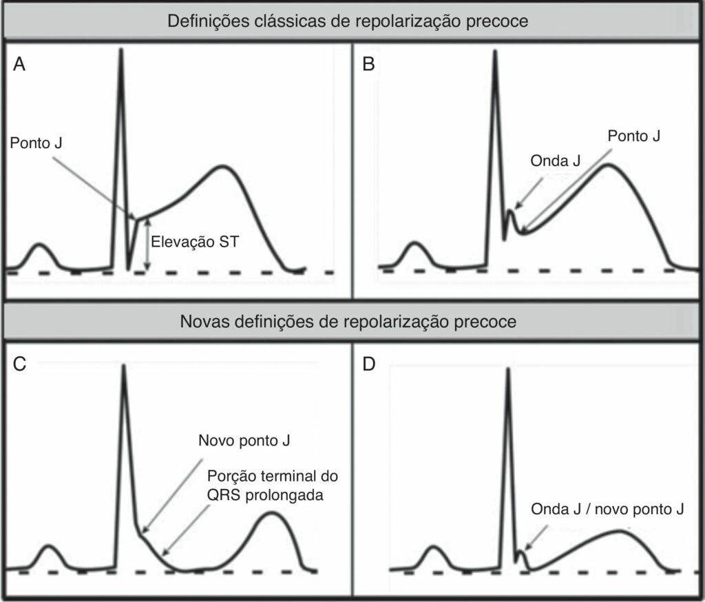 Definições de repolarização precoce