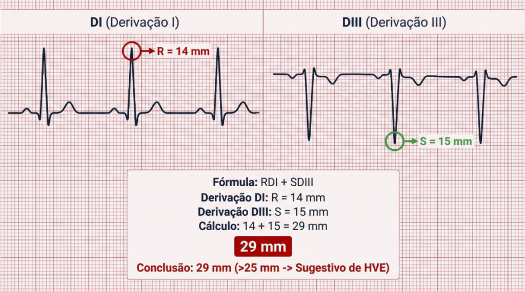 Imagem 2 - Gubner-Ungerleider: RI + SIII > 25 mm. Apesar de ter sensibilidade baixa (14%), sua especificidade é altíssima (97%), sendo um marcador robusto de hipertrofia por hipertensão.